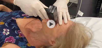 Morpheus8 Treatment For Face