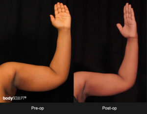 BodyTite Scarless Arm Lift