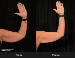 Scarless Female Arm Lift