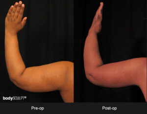 BodyTite Scarless Arm Lift