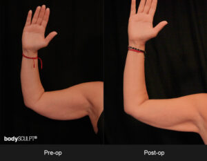 Scarless Arm Lift