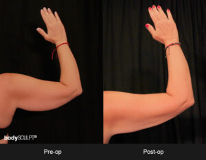 Scarless Arm Lift Surgery