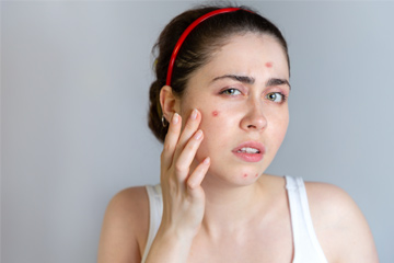 6 Skin Care Habits That Can Worsen Your Acne