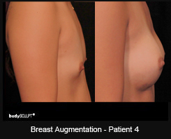 Breast Augmentation - Patient 4