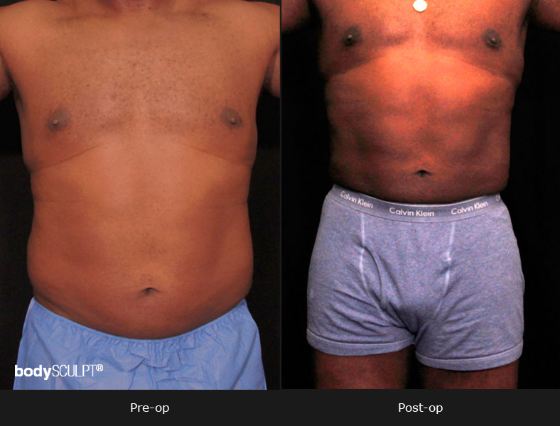 Male Body Contouring Before and After Photos - Patient 1