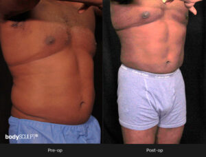 Male Body Contouring Before and After Photos - Patient 1