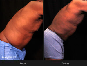 Male Body Contouring Before and After Photos - Patient 1