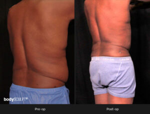 Male Body Contouring Before and After Photos - Patient 1