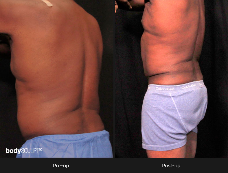 Male Body Contouring Before and After Photos - Patient 1
