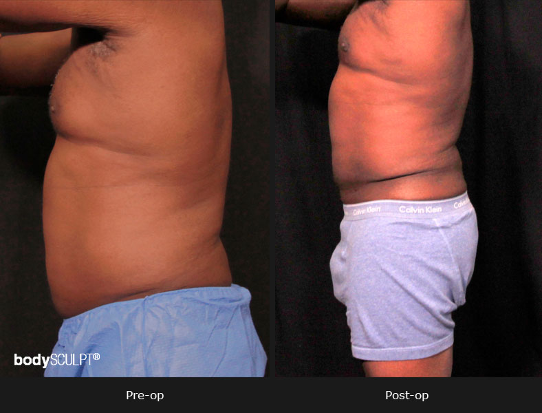 Male Body Contouring Before and After Photos - Patient 1