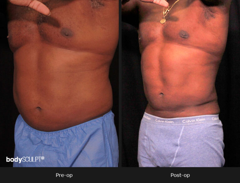 Male Body Contouring Before and After Photos Patient 1