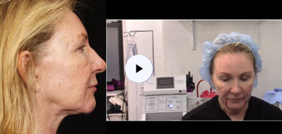 EmbraceRF Facial Rejuvenation Procedure Video: Patient 1