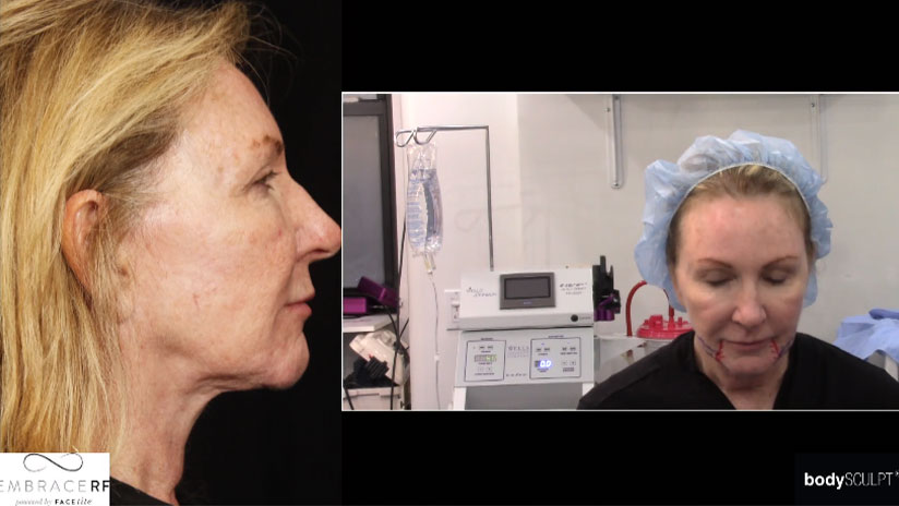 Facial Rejuvenation Procedure Video