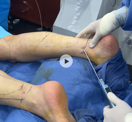 Calf Liposuction with BodyTite in NYC