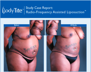 Radio-Frequency Assisted Liposuction - Case Study
