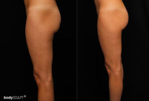 Brazilian Butt Lift