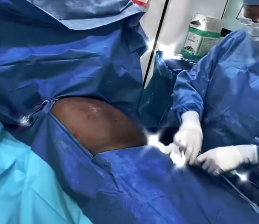 High Def BodyTite/Vaser Abdominal Surgery