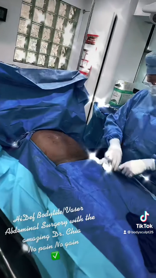 High Def BodyTite/Vaser Abdominal Surgery