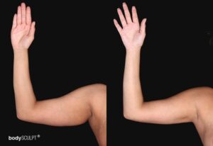 Arm liposuction