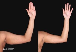 Arm liposuction