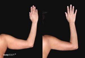 Arm liposuction