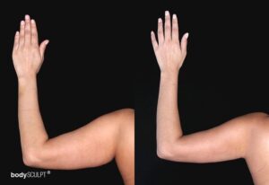 Arm liposuction