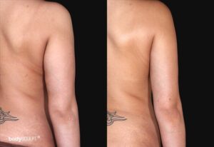 Arm liposuction