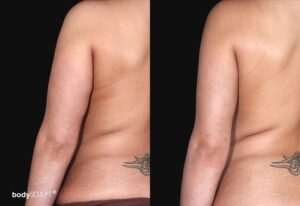 Arm liposuction