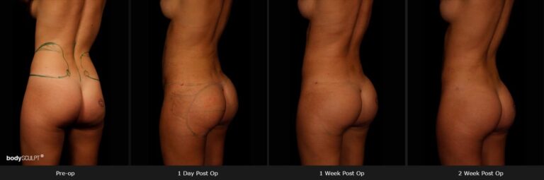 Brazilian Butt Lift - Before & After Photos
