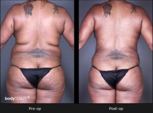 BodyTite Liposuction