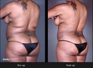 BodyTite Liposuction