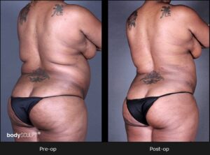 BodyTite Liposuction