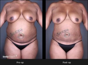 BodyTite Liposuction