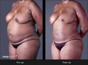 BodyTite Liposuction