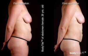 BodyTite Liposuction