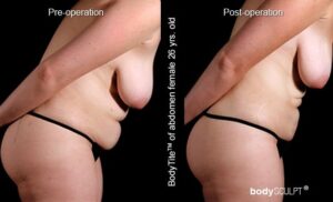 BodyTite Liposuction