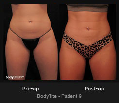 BodyTite