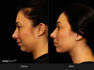 Kybella Double Chin Treatment