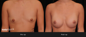Breast Augmentation - Patient 4 Before & After Photos