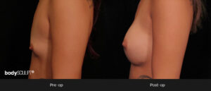 Breast Augmentation - Patient 4 Before & After Photos