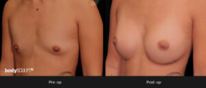 Breast Augmentation - Patient 4 Before & After Photos