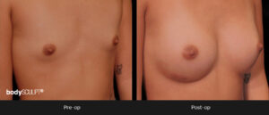 Breast Augmentation - Patient 4 Before & After Photos