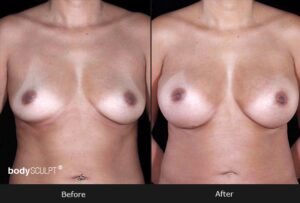 Breast Augmentation - Patient 1 Before & After Photos