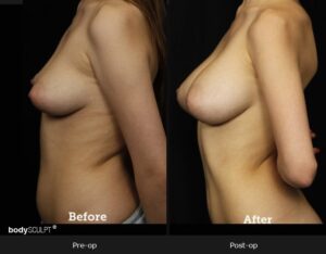 Breast Augmentation - Patient 2 Before & After Photos