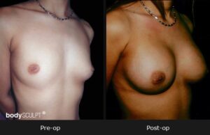 Breast Augmentation - Patient 3 Before & After Photos