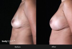 Breast Augmentation - Patient 1 Before & After Photos
