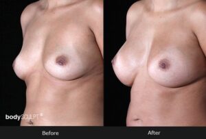 Breast Augmentation - Patient 1 Before & After Photos