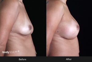 Breast Augmentation - Patient 1 Before & After Photos