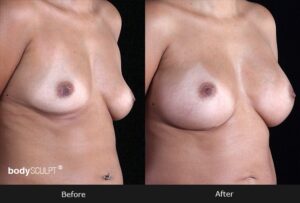 Breast Augmentation - Patient 1 Before & After Photos