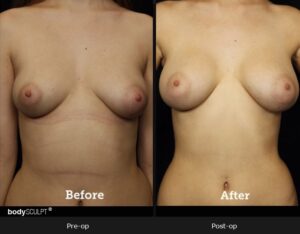 Breast Augmentation - Patient 2 Before & After Photos